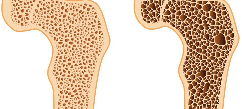 Osteoporóza - tichý zloděj kostí