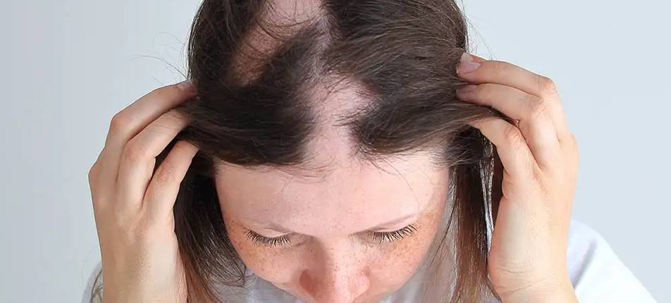 Alopecie - Zákeřná nemoc
