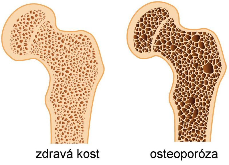 Osteoporóza - tichý zloděj kostí