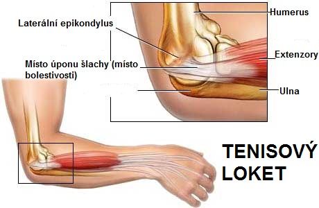 epicondylitis lateralis humeri