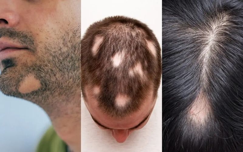 Alopecie