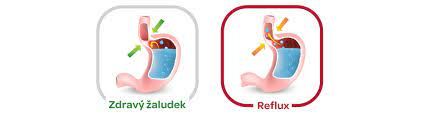 reflux